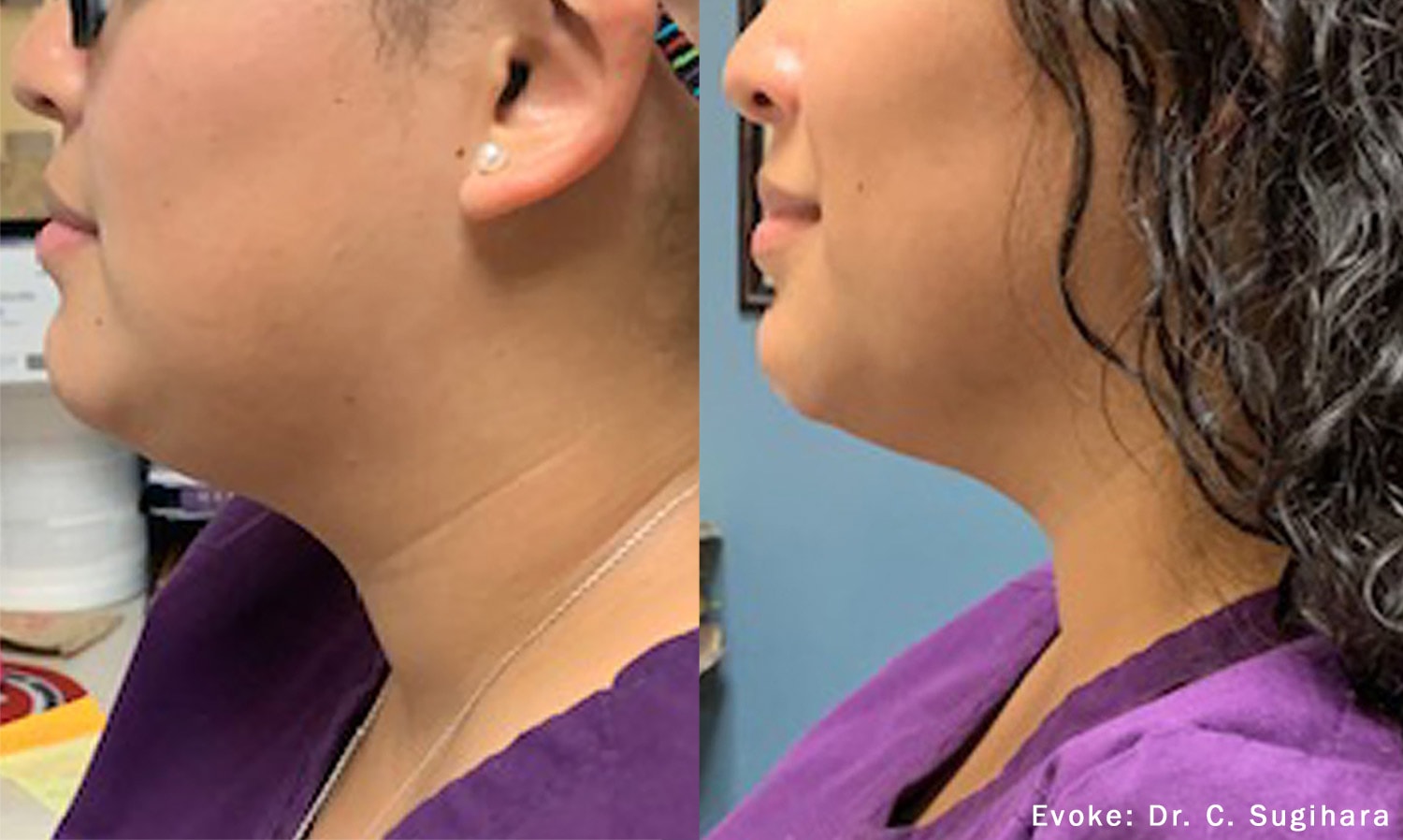 Evoke neck treatment before and after photo by Dr. Sugihara