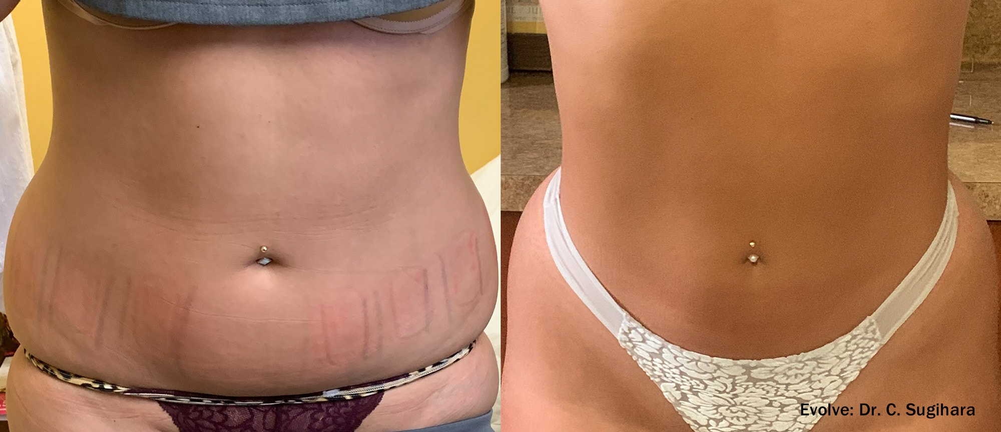 Evolve abdomen treatment before and after photo by Dr. Sugihara