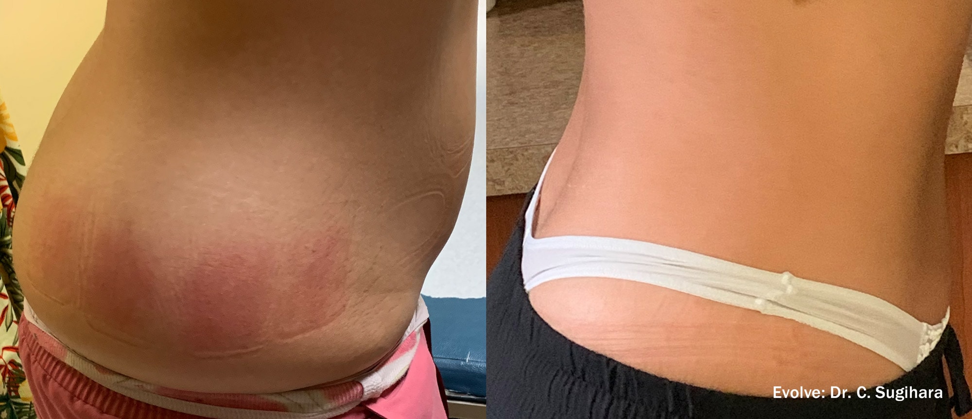 Evolve hip treatment before and after photo by Dr. Sugihara