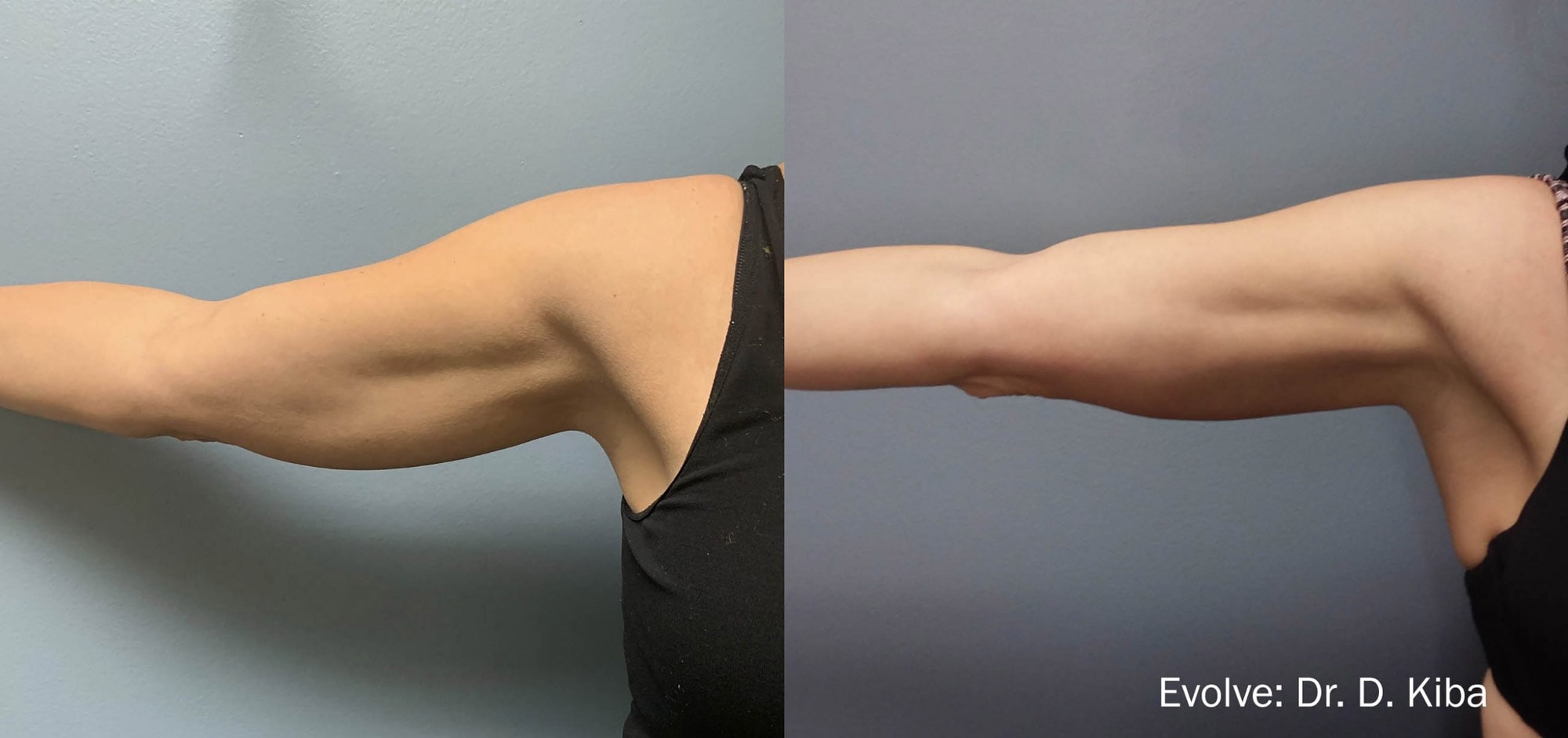 Evolve arm treatment before and after photo by Dr. Kiba