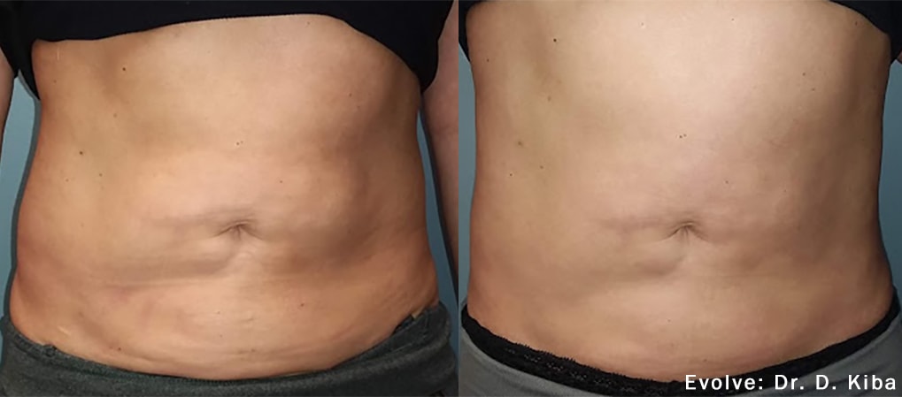Evolve abdomen treatment before and after photo by Dr. Kiba
