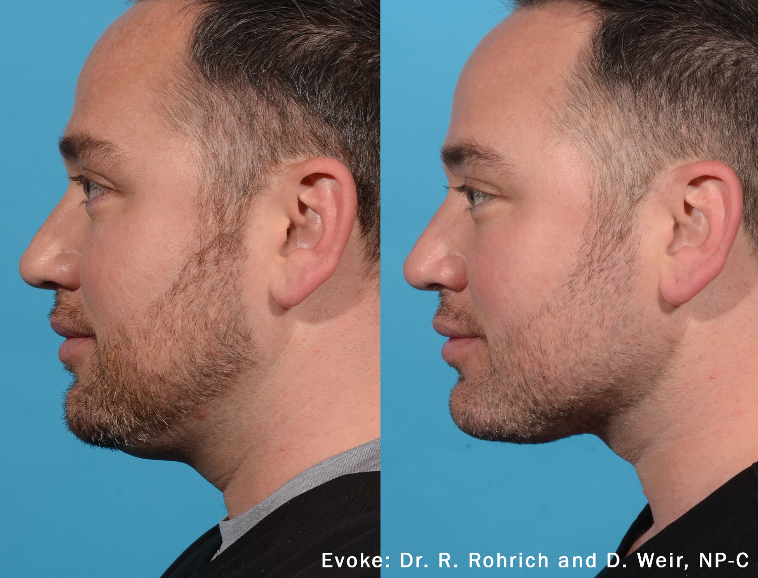 Evoke neck treatment before and after photo by Dr. Rohrich and Certified Nurse Practitioner Weir