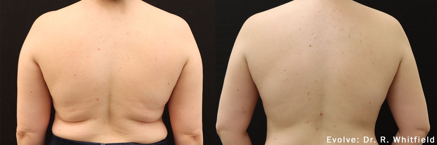 Evolve back treatment before and after photo by Dr. Whitfield