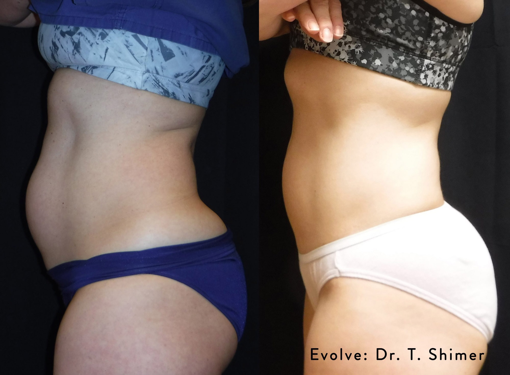 Evolve abdomen treatment before and after photo by Dr. Shimer