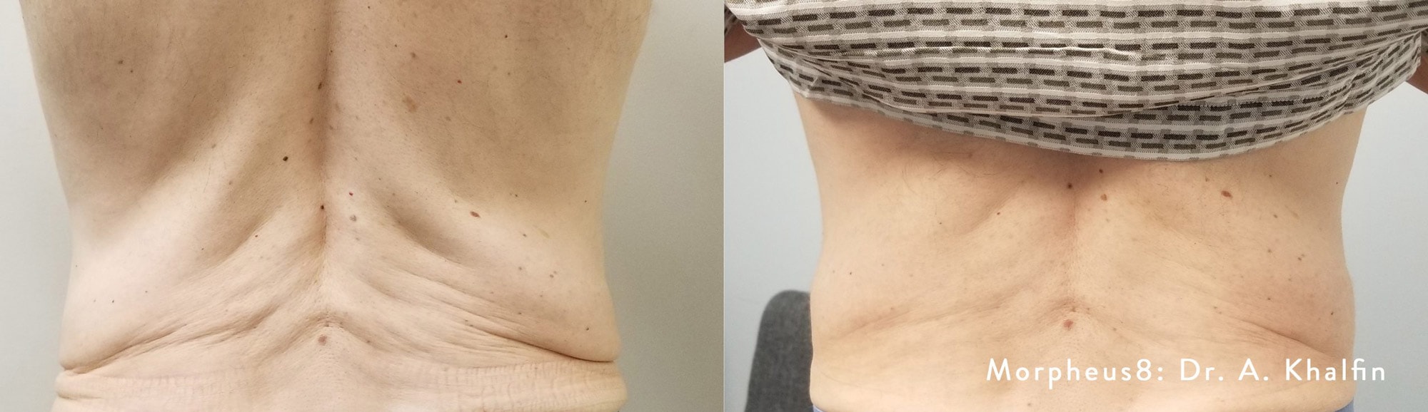 Morpheus8 treatment on back by Dr. Khalfin