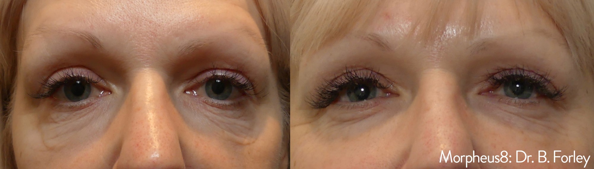 Morpheus treatment under eyes before and after photos by Dr. Forley