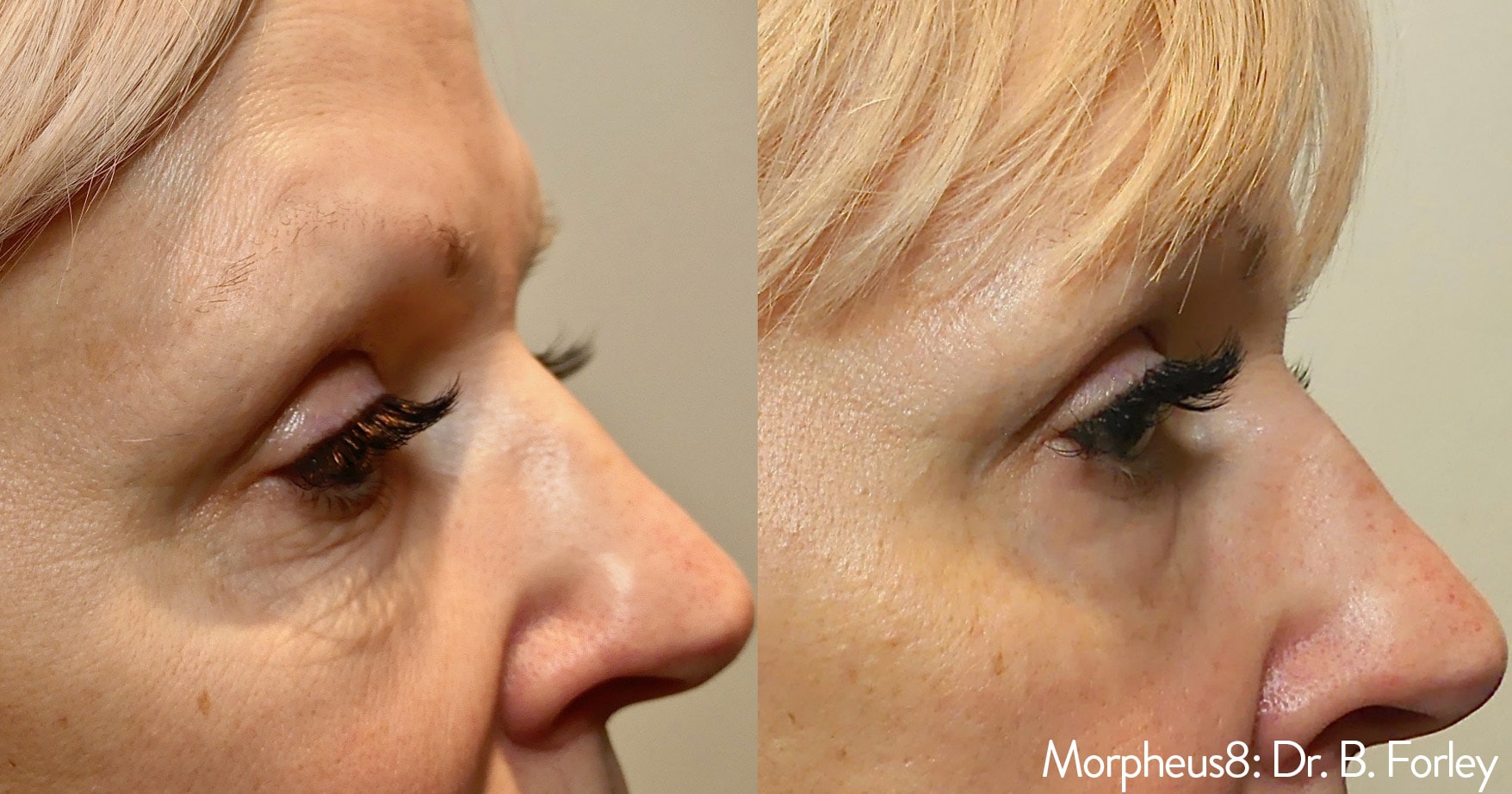 Morpheus treatment under eyes before and after photos by Dr. Forley