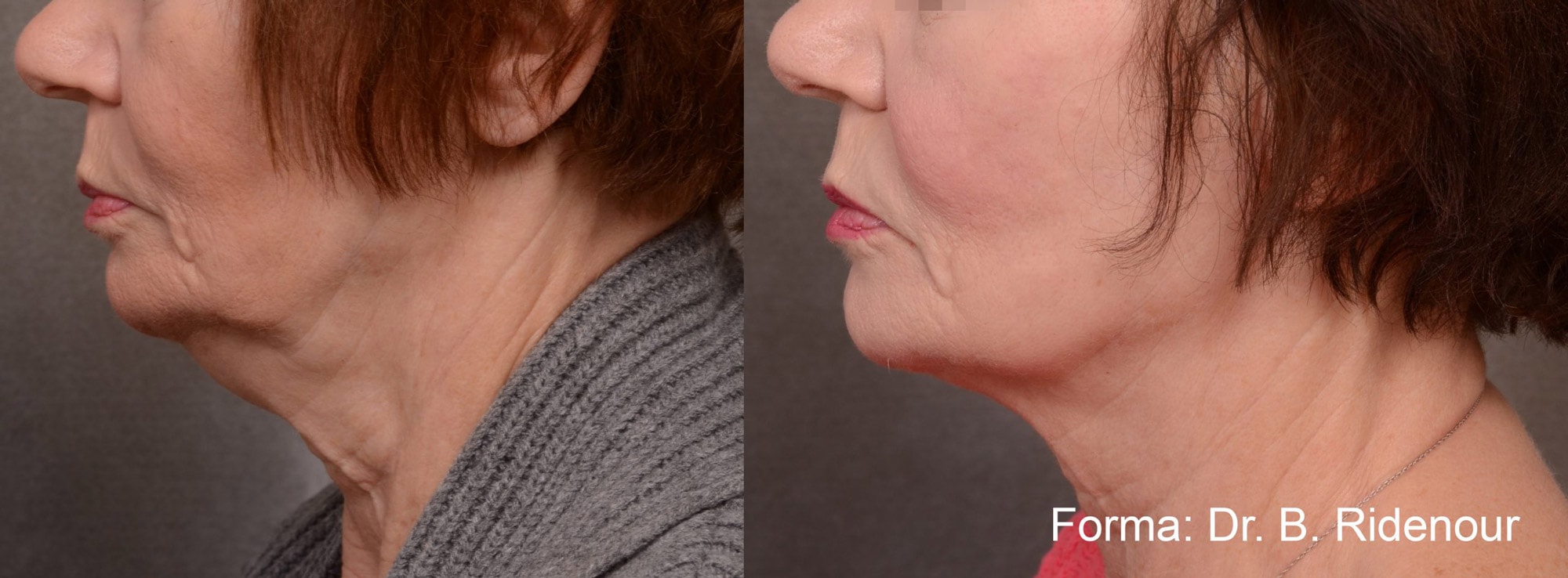 Forma treatment on the neck before and after photos by Dr. Ridenour