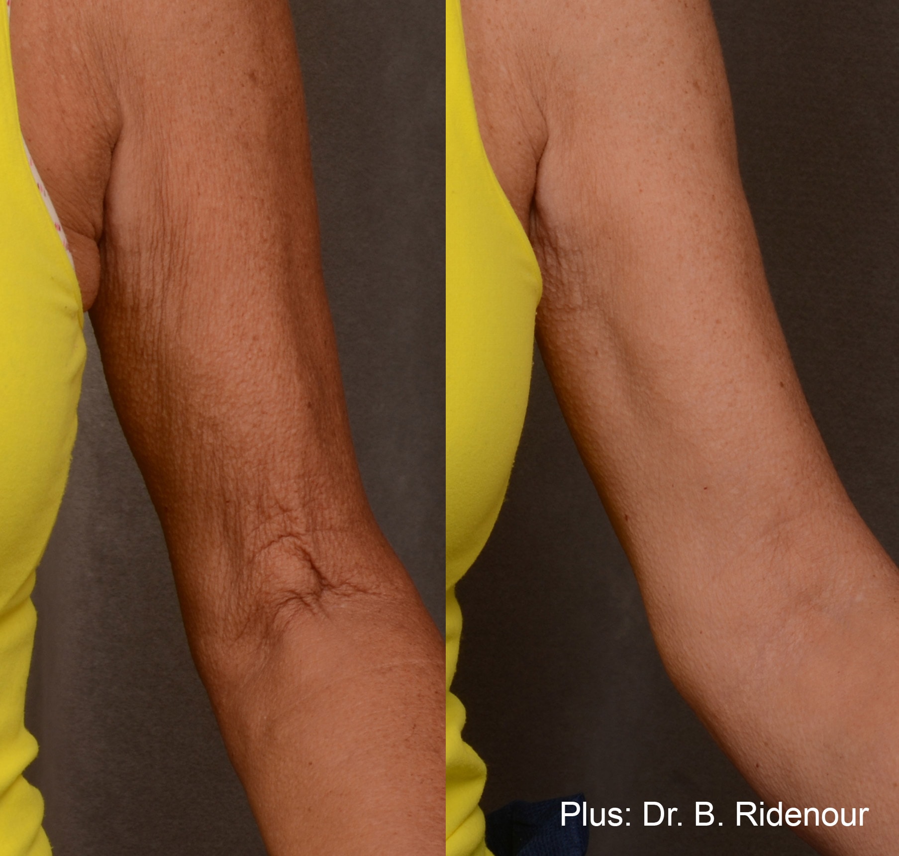 Forma Plus treament on upper arm before and after photos by Dr. Ridenour