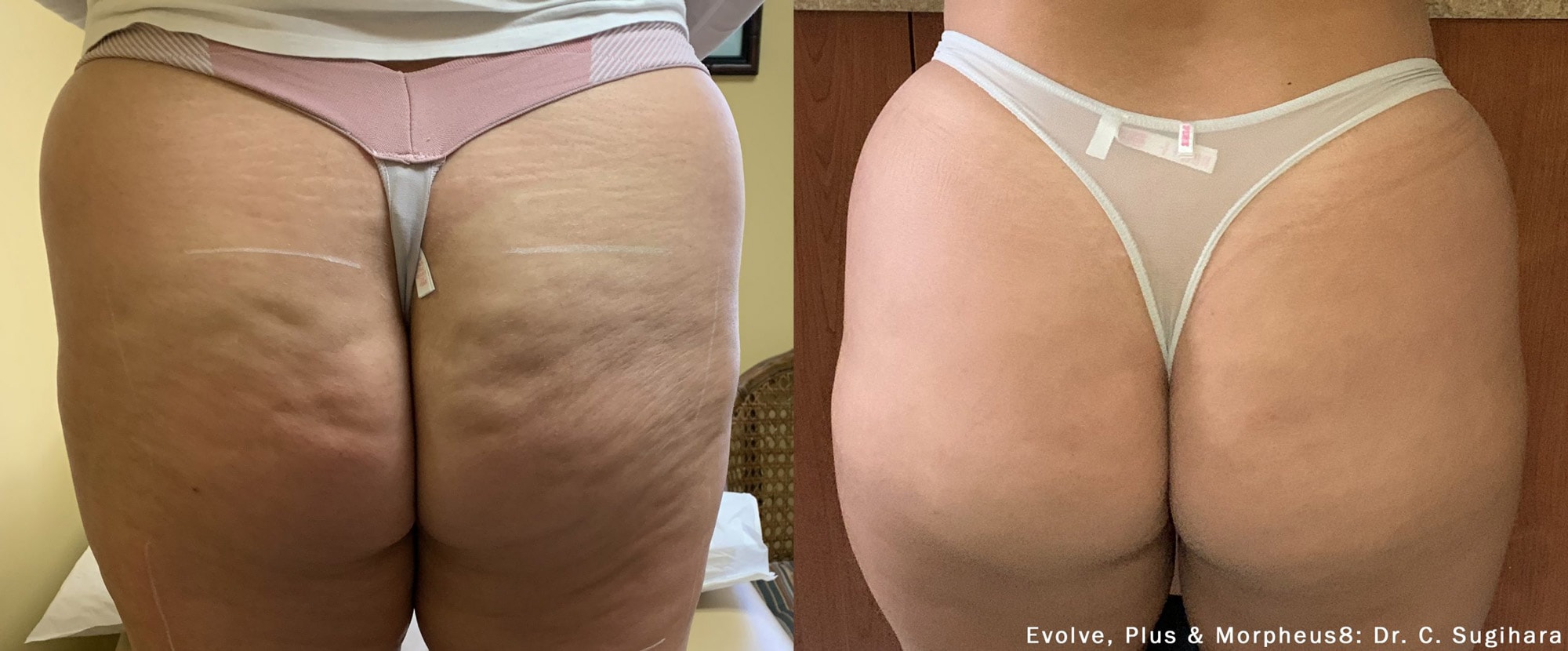 Evolve plus and Morpheus8 cellulite treatment before and after photo by Dr. Sugihara