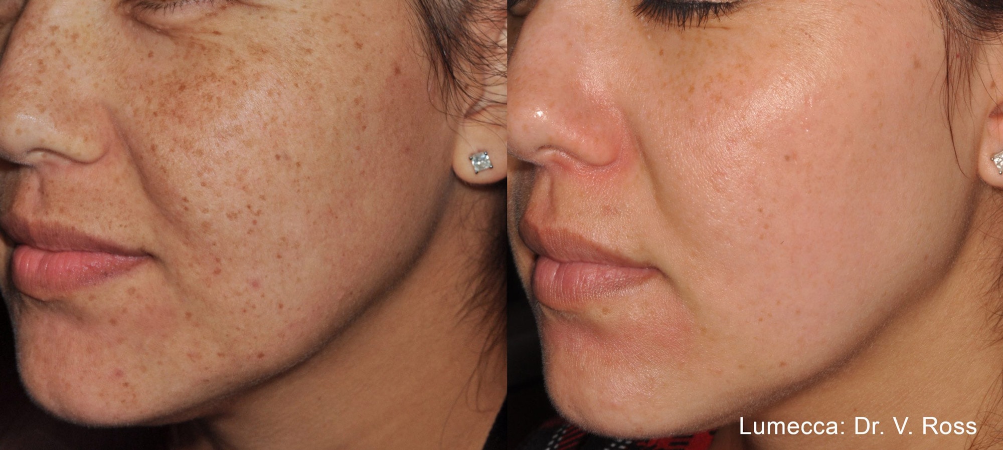 Lumecca facial pigmentation treatment before and after photos by Dr. Ross