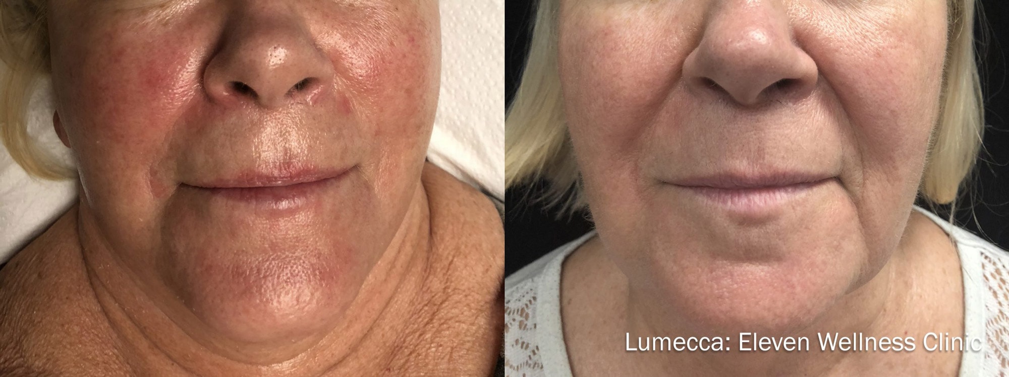 Lumecca facial pigmentation treatment before and after photos by Eleven Wellness