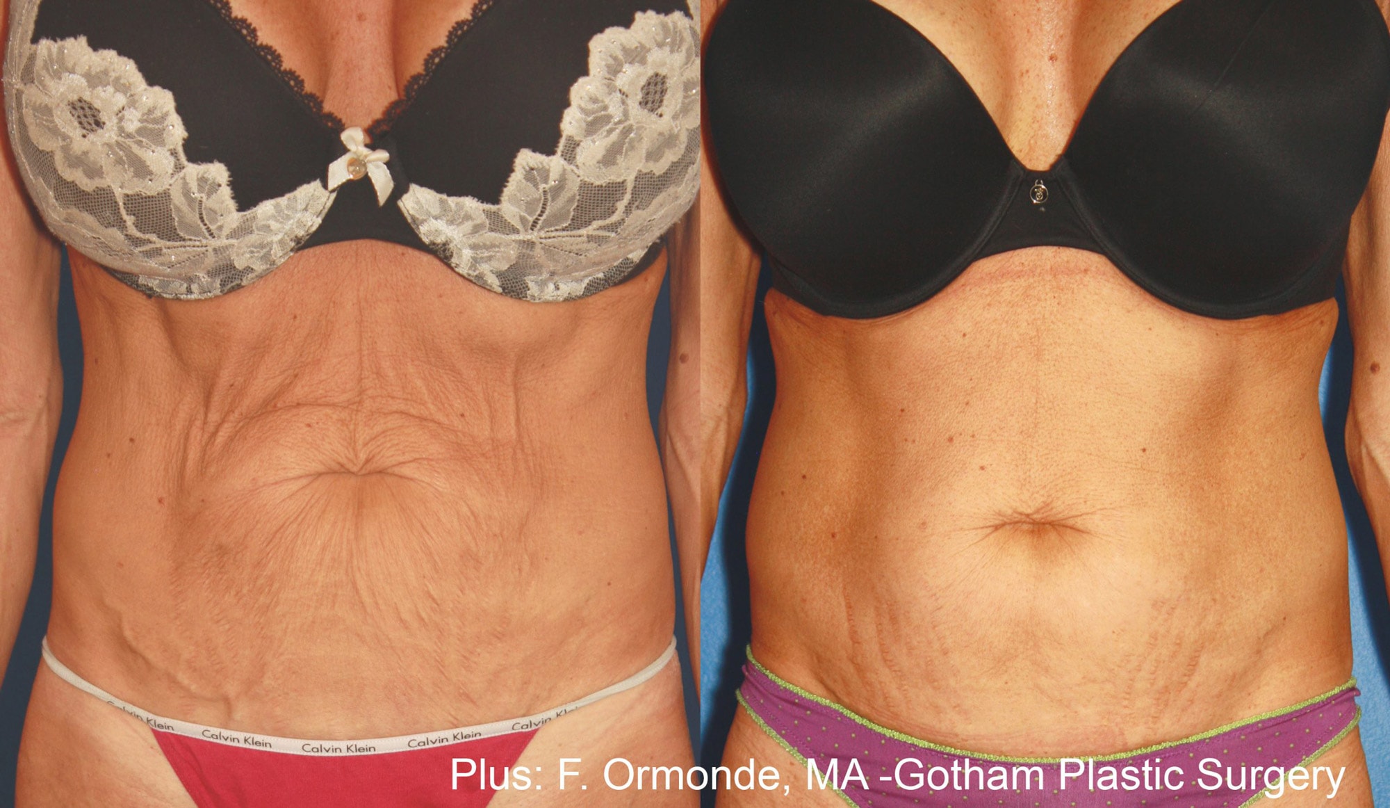 Forma Plu streament on abdomen