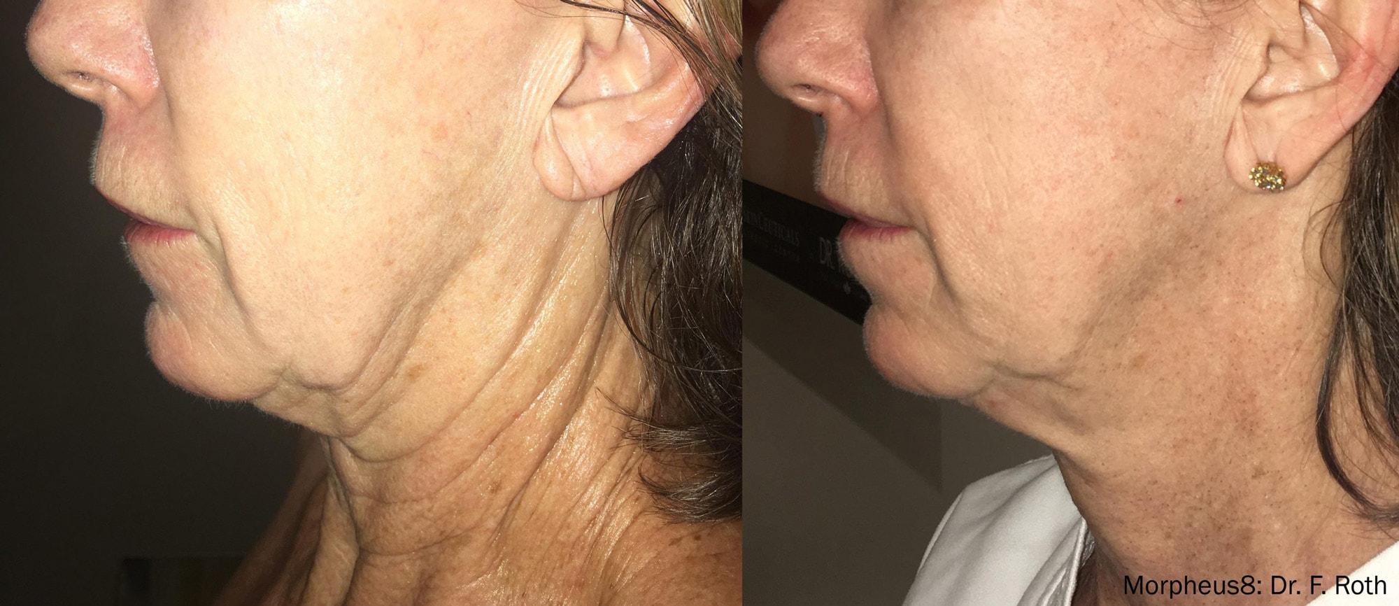 Morpheus8 treatment on the neck before and after photos by Dr. Roth