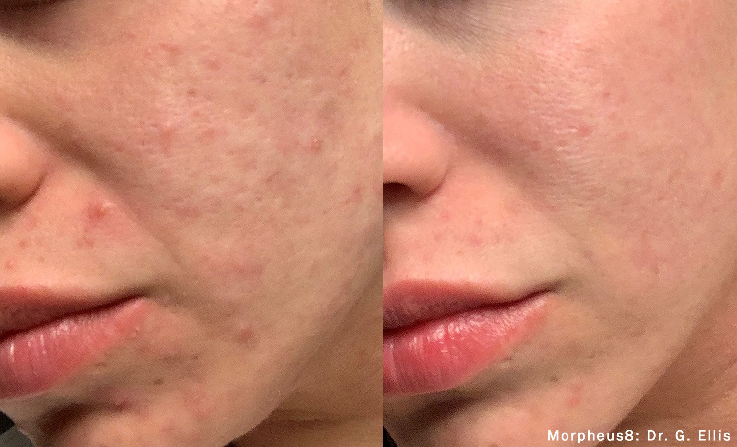 Morpheus facial acne treatment before and after photos by Dr. Ellis