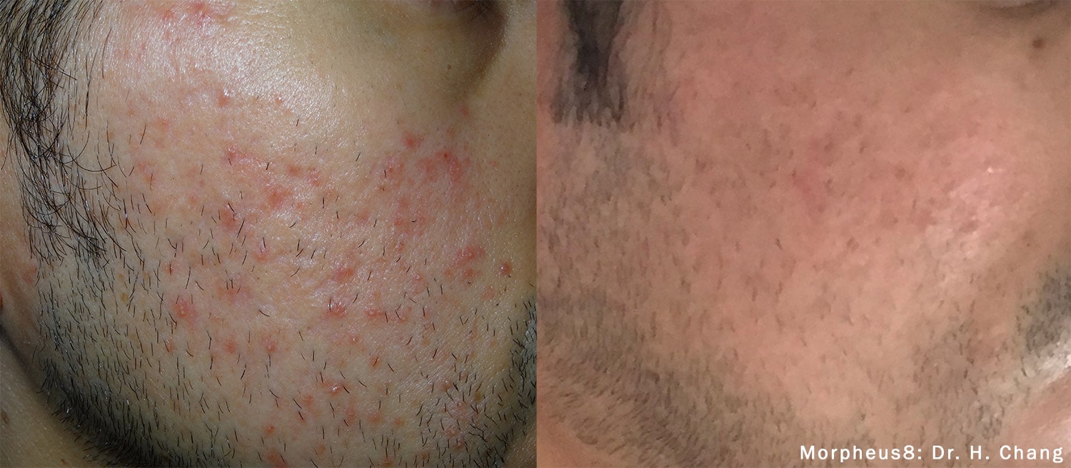Morpheus8 facial acne treatment before and after photos by Dr. Chang