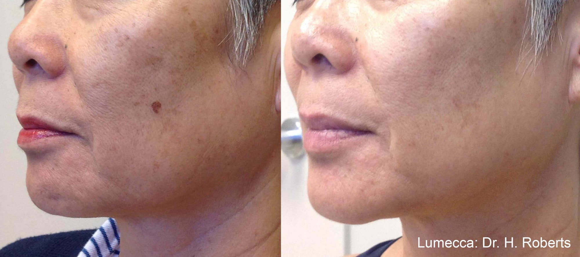 Lumecca facial pigmentation treatment before and after photos by Dr. Roberts