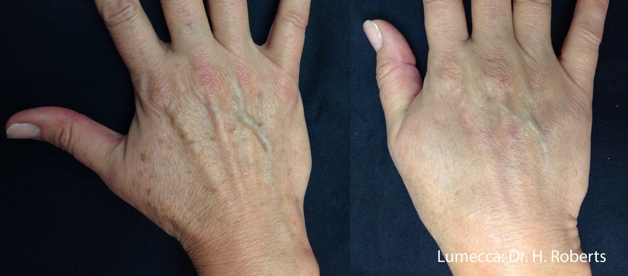 Lumecca pigmentation treatment on hands before and after photos by Dr. Roberts