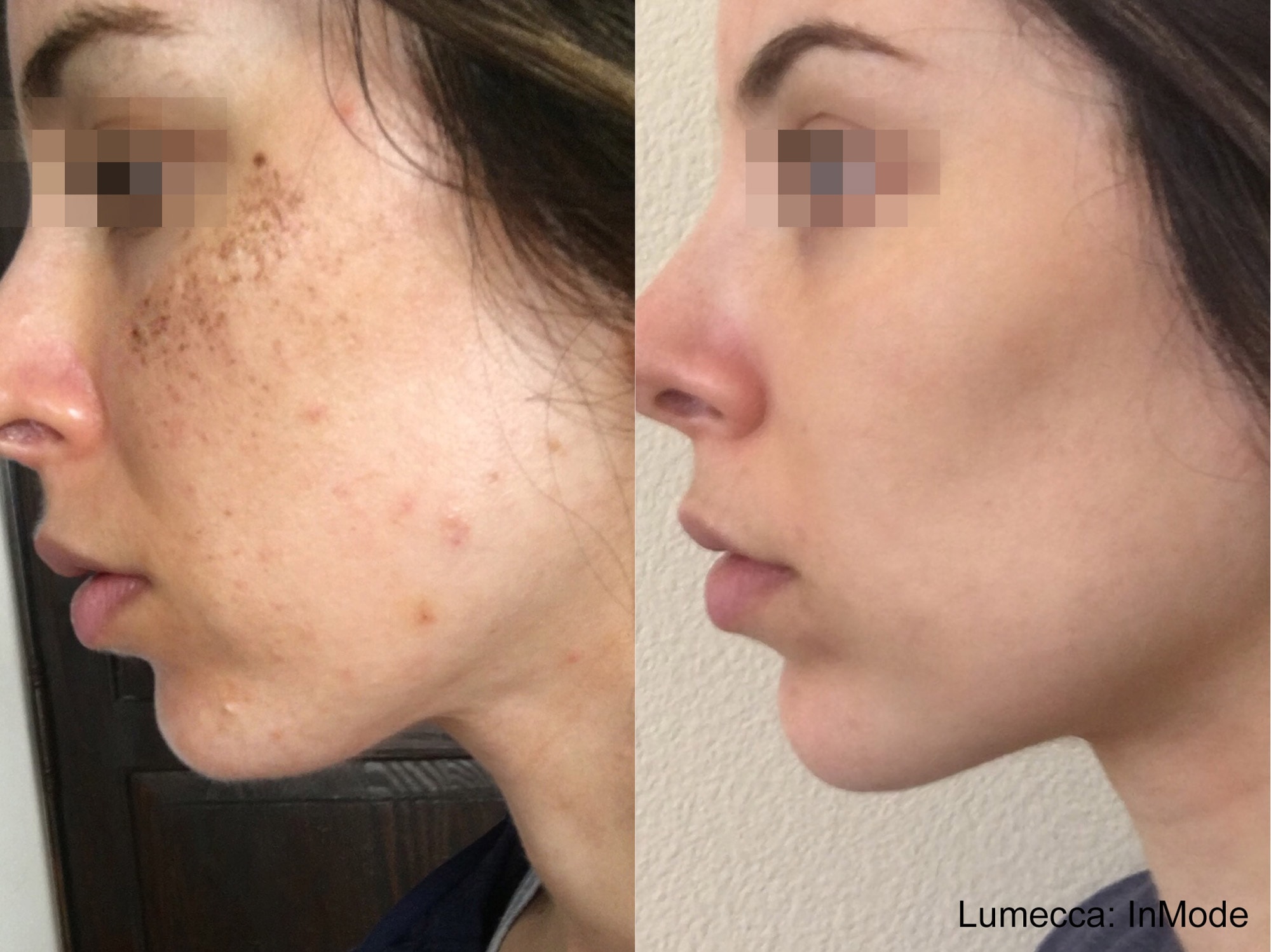 Lumecca facial acne and pigmentation treatment before and after photos by InMode