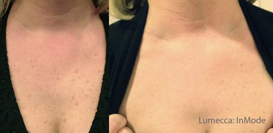 Lumecca decolettage pigmentation treatment before and after photos by InMode