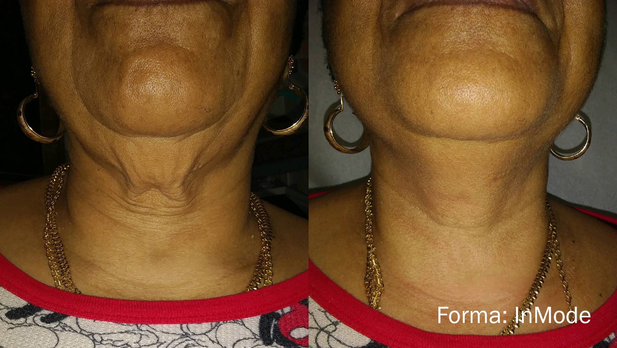 Forma treatment on the neck before and after photos by InMode