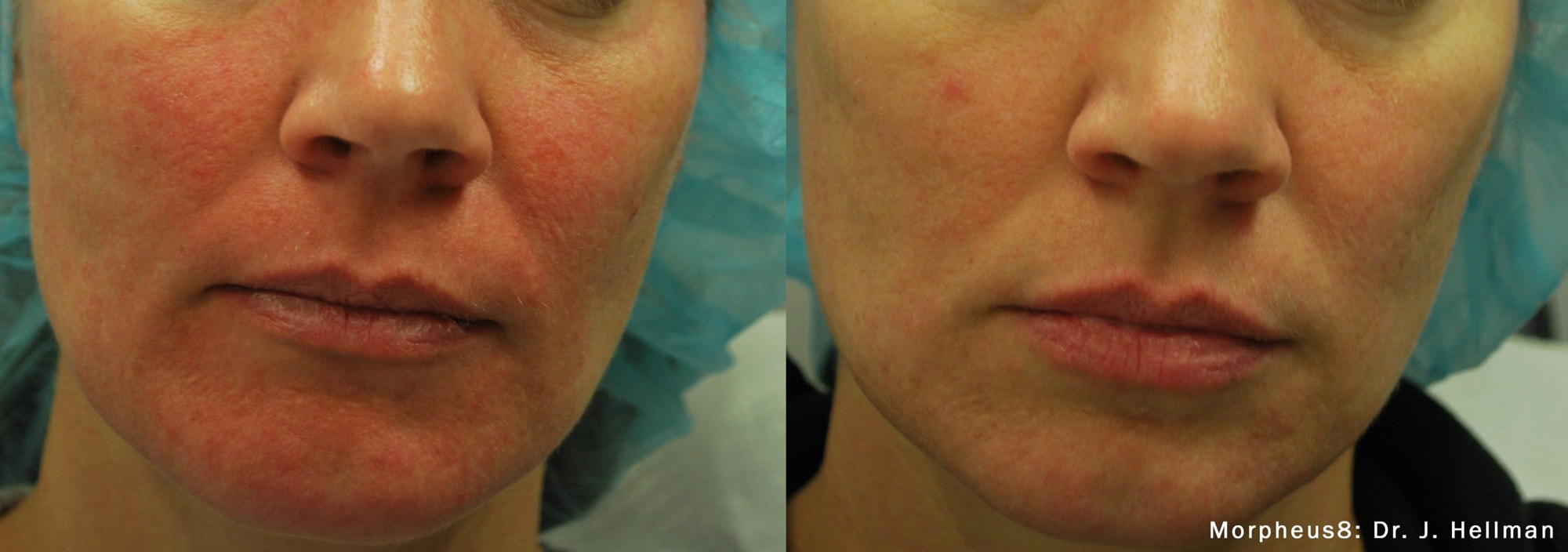 Morpheus8 facial acne treatment before and after photos by Dr. Hellman