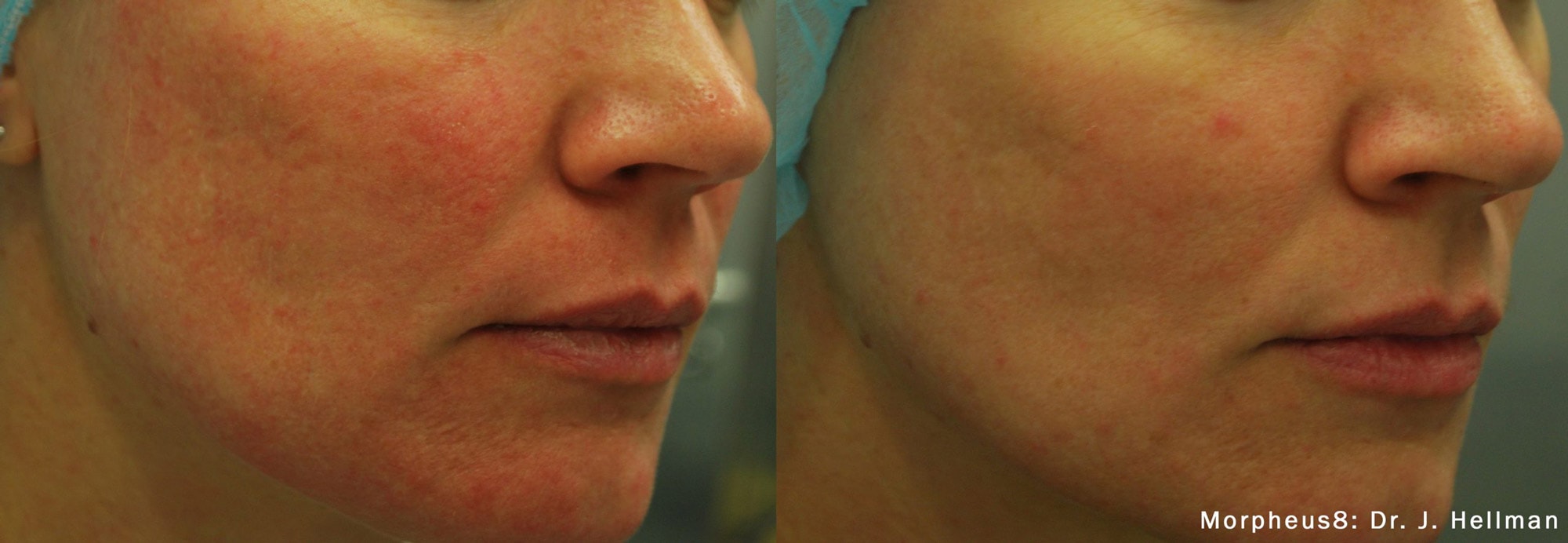 Morpheus8 facial acne treatment before and after photos by Dr. Hellman