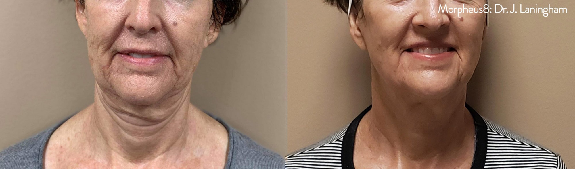 Morpheus treatment on neck before and after photos by Dr. Laningham