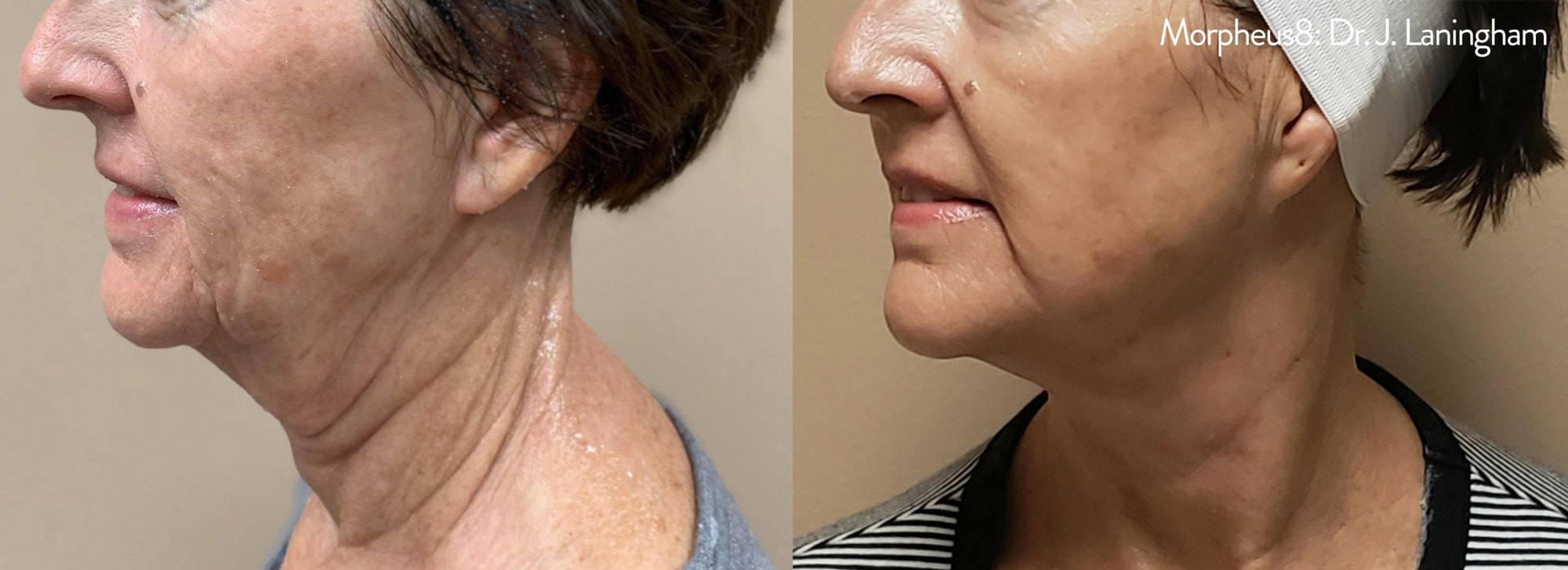Morpheus treatment on neck before and after photos by Dr. Laningham