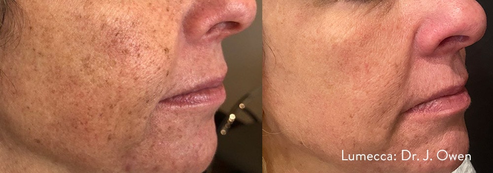 Lumecca facial pigmentation treatment before and after photos by Dr. Owen
