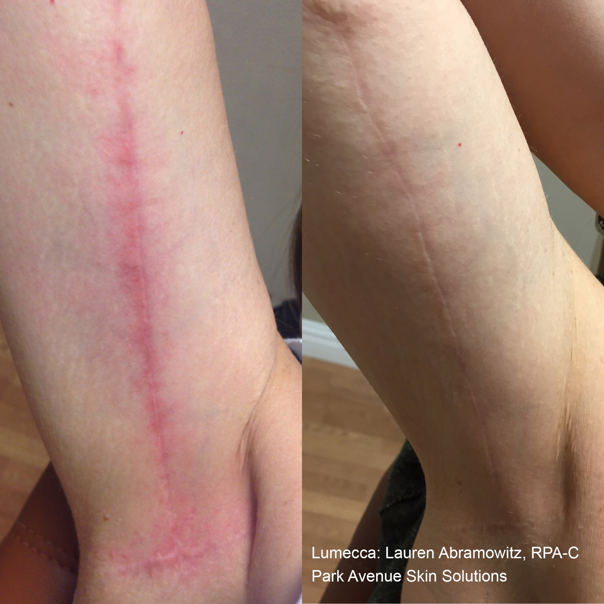 Lumecca scar treatment before and after photos by Abramowitz, RPA-C