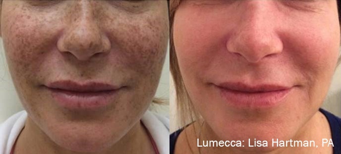 Lumecca facial pigmentation treatment before and after photos by Hartman, PA