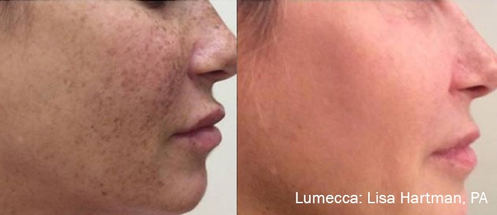 Lumecca facial pigmentation treatment before and after photos by Hartman, PA