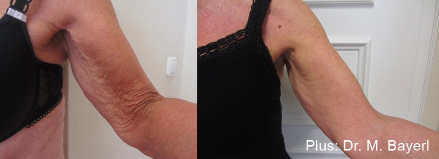 Forma Plus treament on upper arm before and after photos by Dr. Bayeri