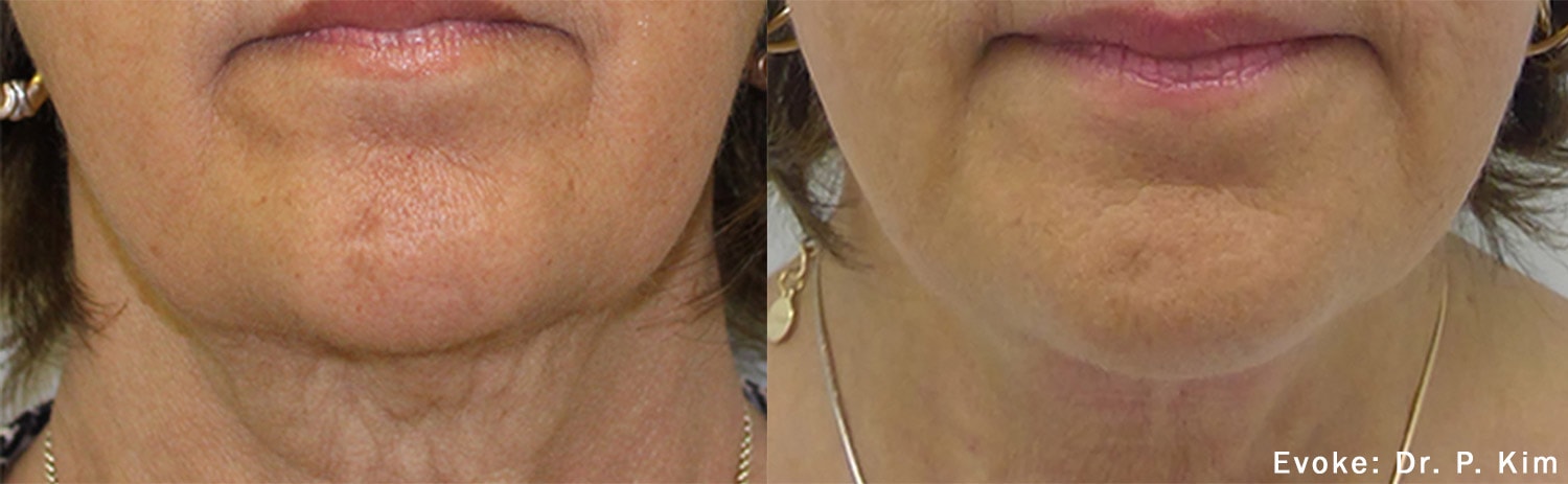 Evoke treatment on the chin before and after photos by Dr. Kim