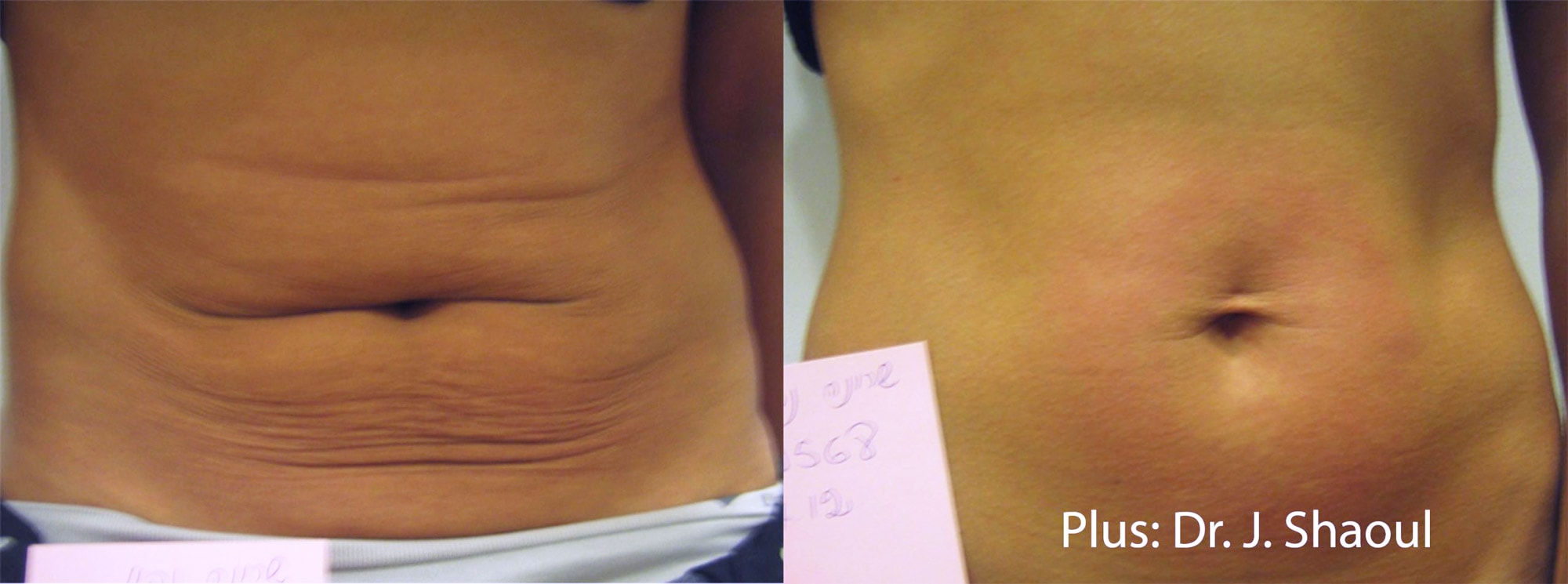 Forma Plus treatment on abdomen before and after photos by Dr. Shaoul
