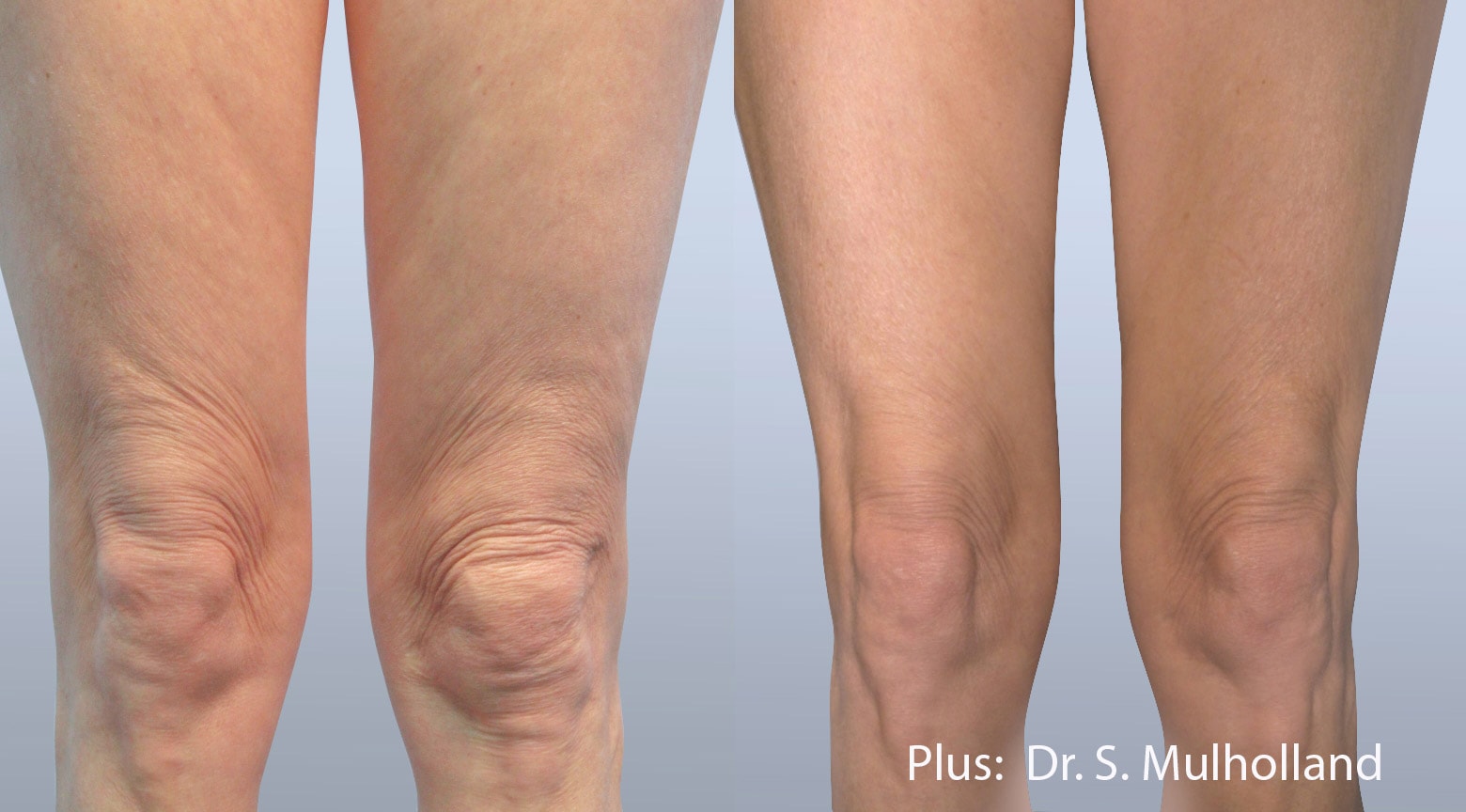 Forma Plus treatment on thighs before and after photos by Dr. Mulholland
