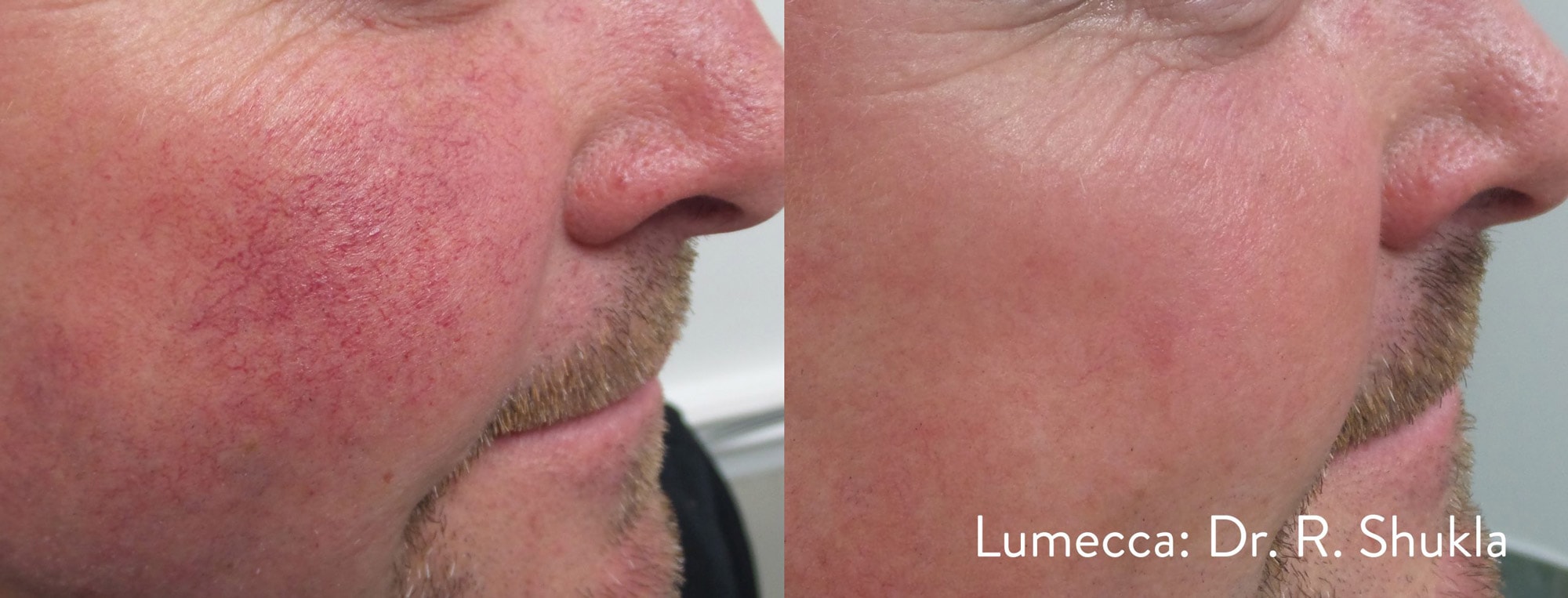 Lumecca broken capillaries pigmentation treatment before and after photos by Dr. Shukla