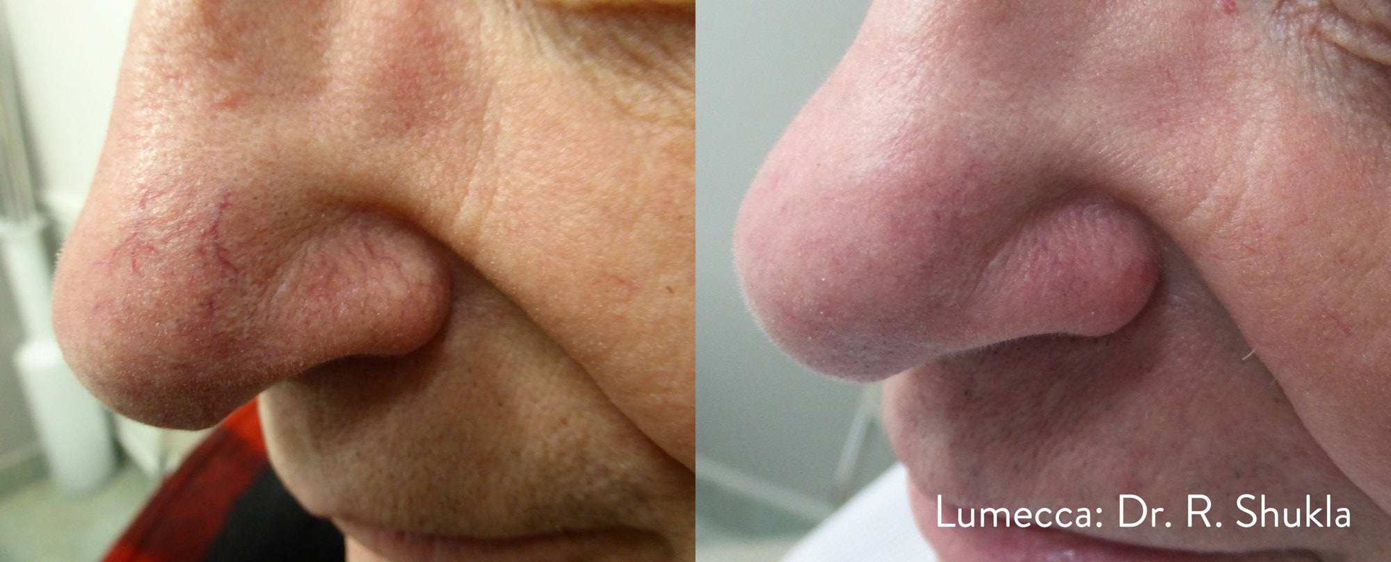 Lumecca broken capillaries pigmentation treatment before and after photos by Dr. Shukla