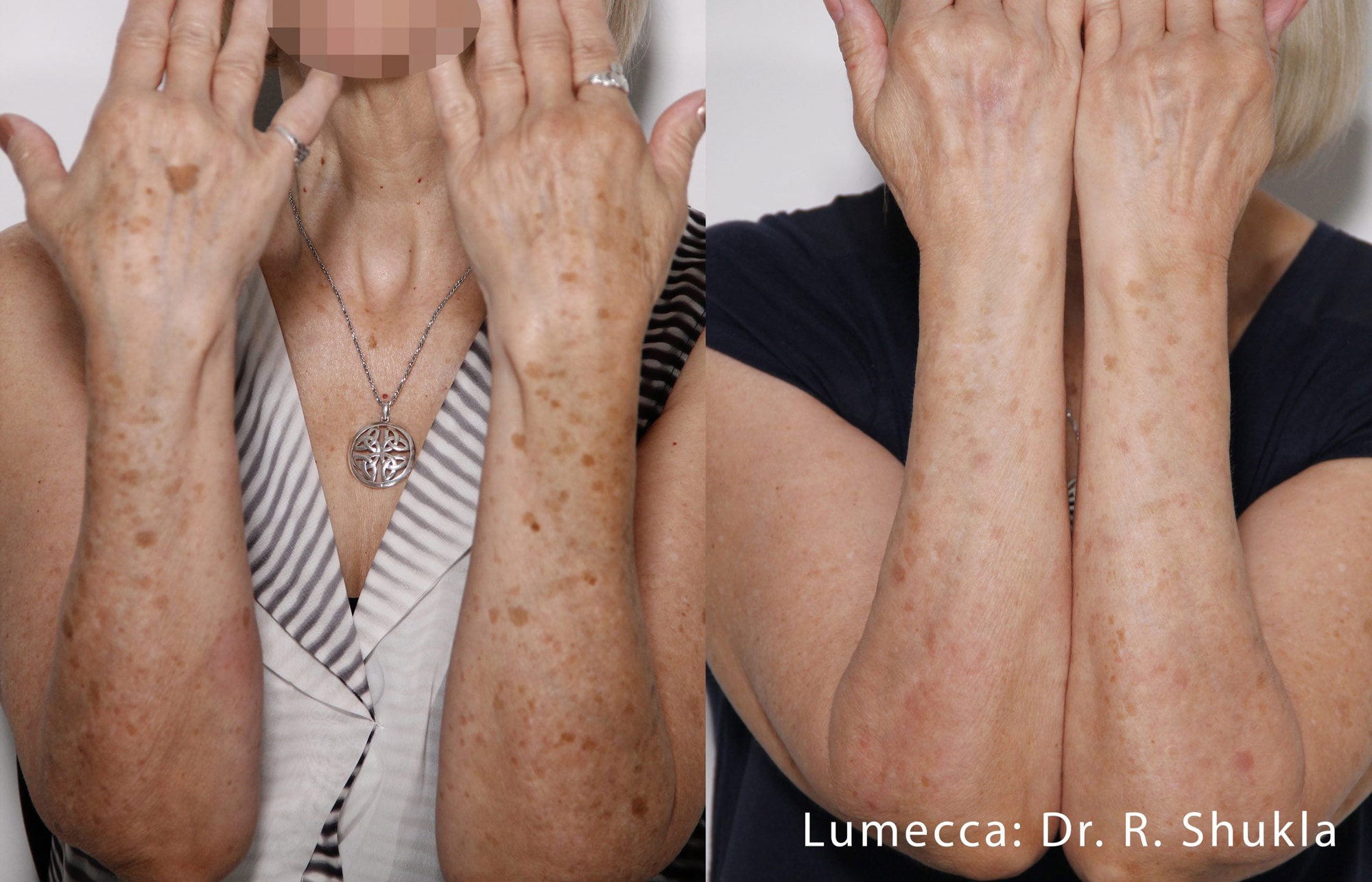 Lumecca facial pigmentation treatment before and after photos by Dr. Shukla