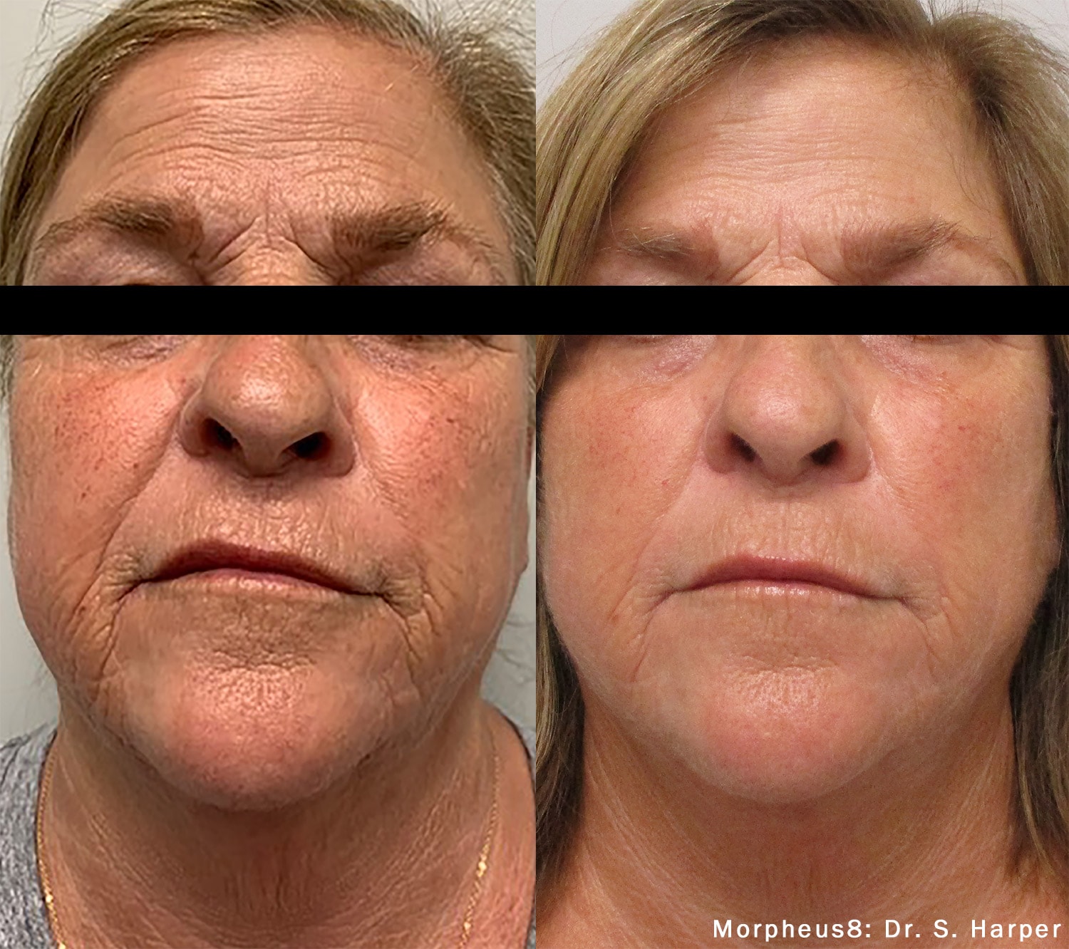 Morpehus8 treatment on the face before and after photos by Dr. Harper