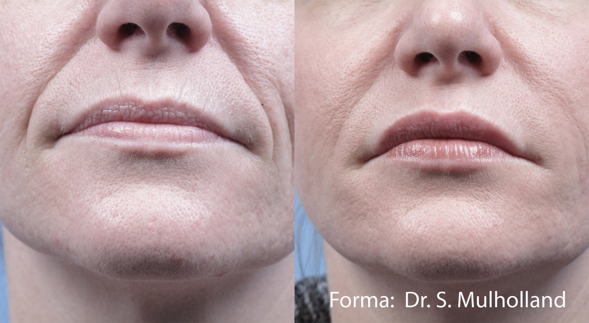 Forma treatment on the face before and after photos by Dr. Mulholland