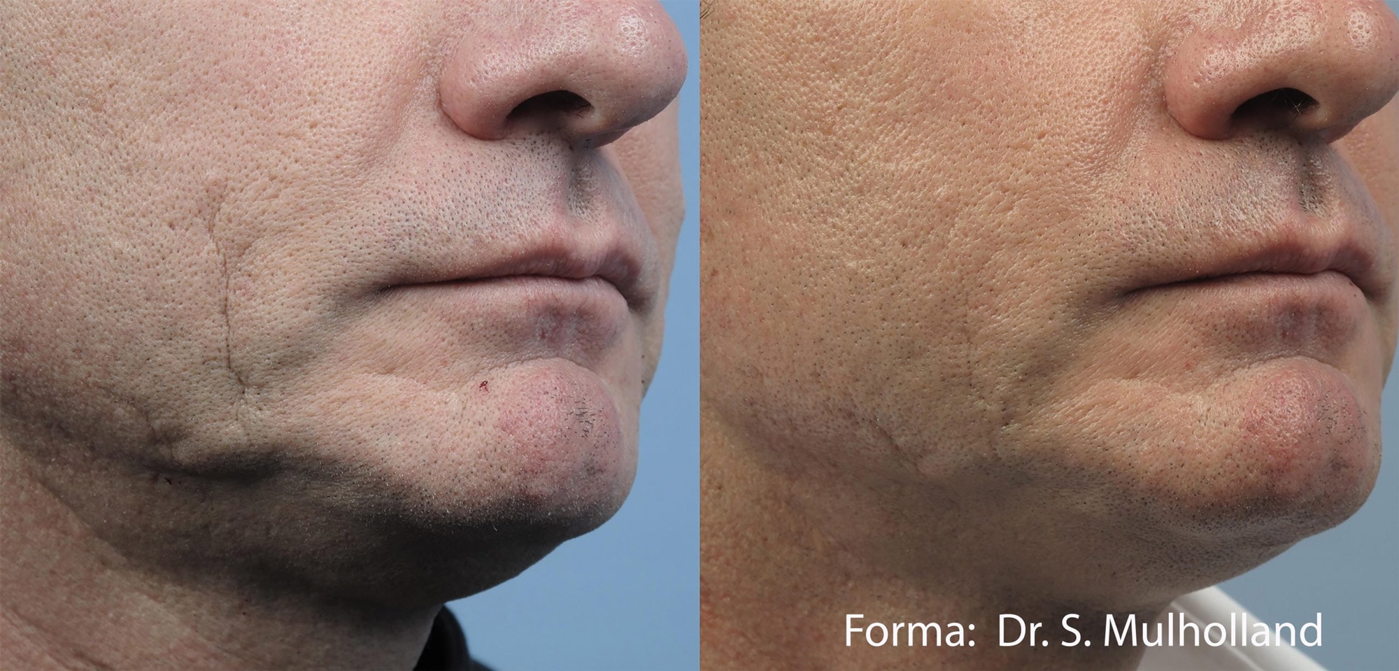 Forma facial treatment before and after photos by Dr. Mulholland