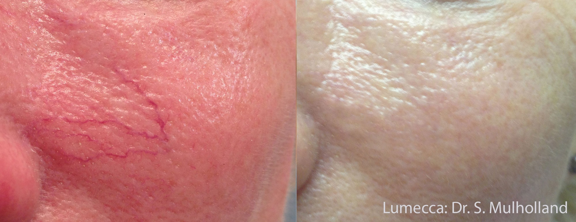 Lumecca broken capillaries pigmentation treatment before and after photos by Dr. Mulholland