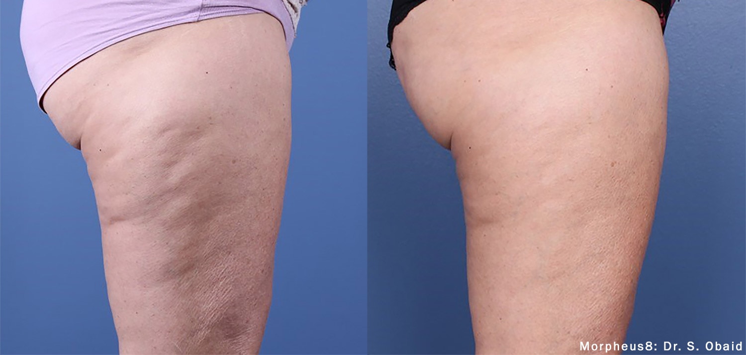 Morpheus8 cellulite treatment on thighs beofre and after photos by Dr. Obaid