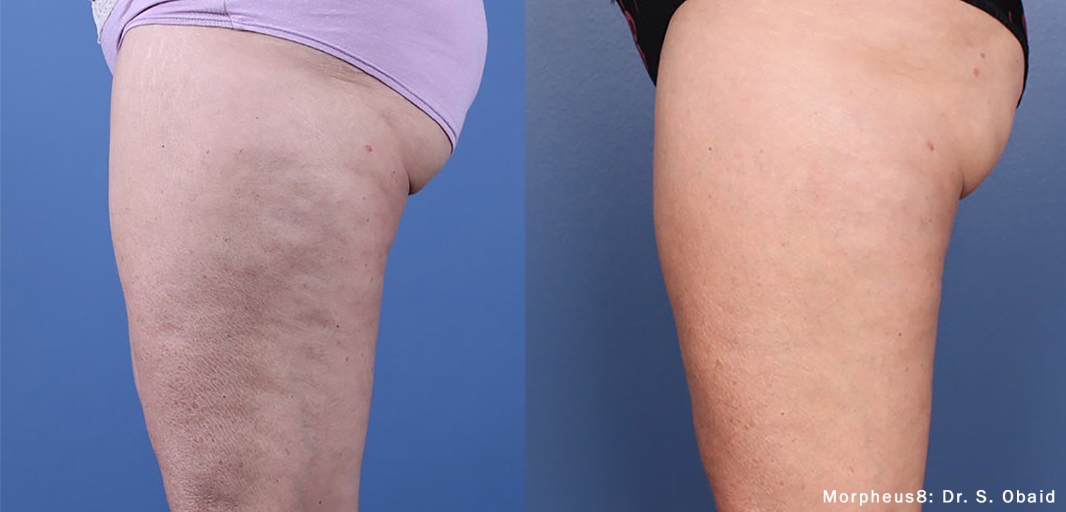 Morpheus8 cellulite treatment on thighs beofre and after photos by Dr. Obaid