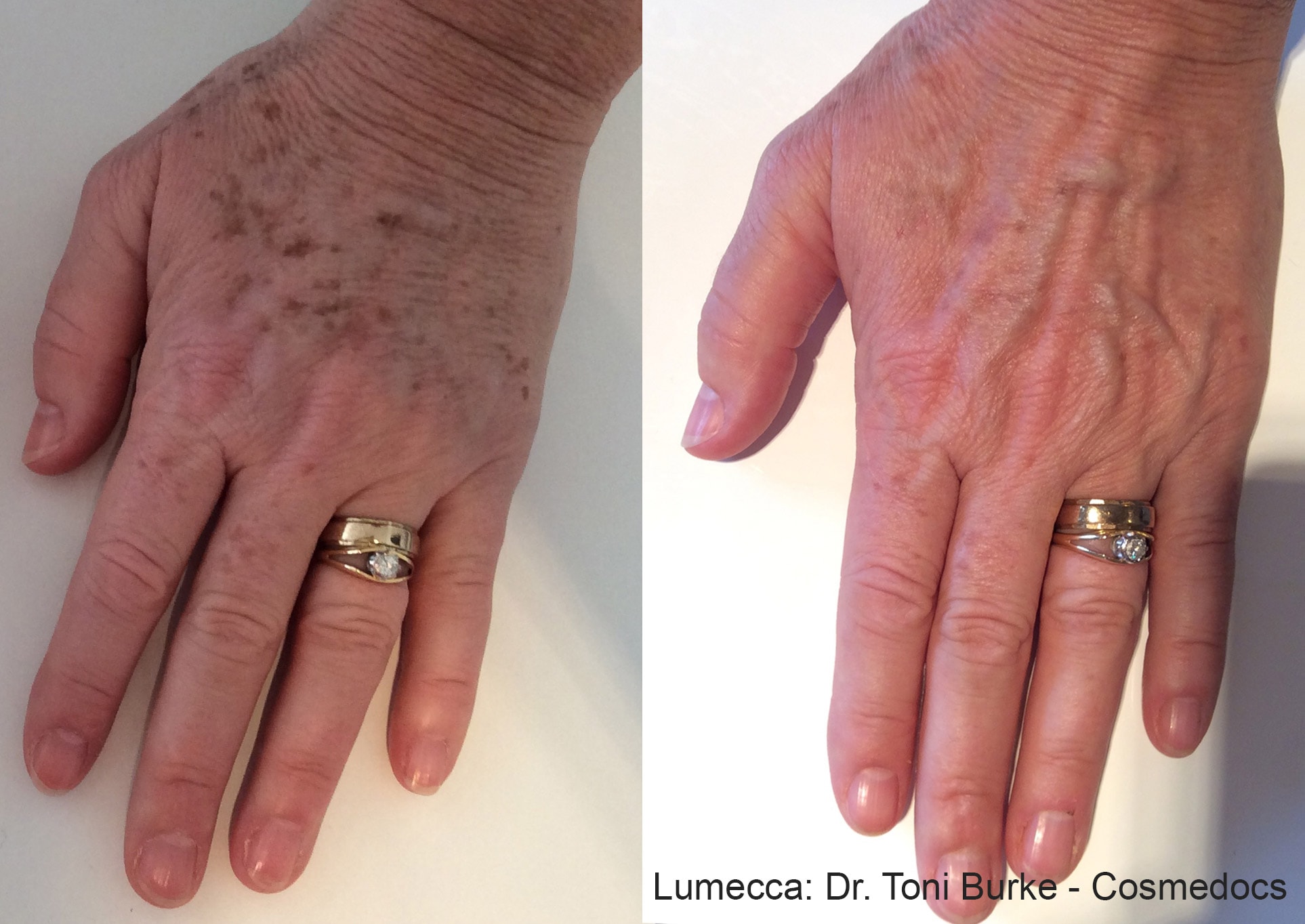 Lumecca pigmentation on hands treatment before and after photos by Dr. Burke